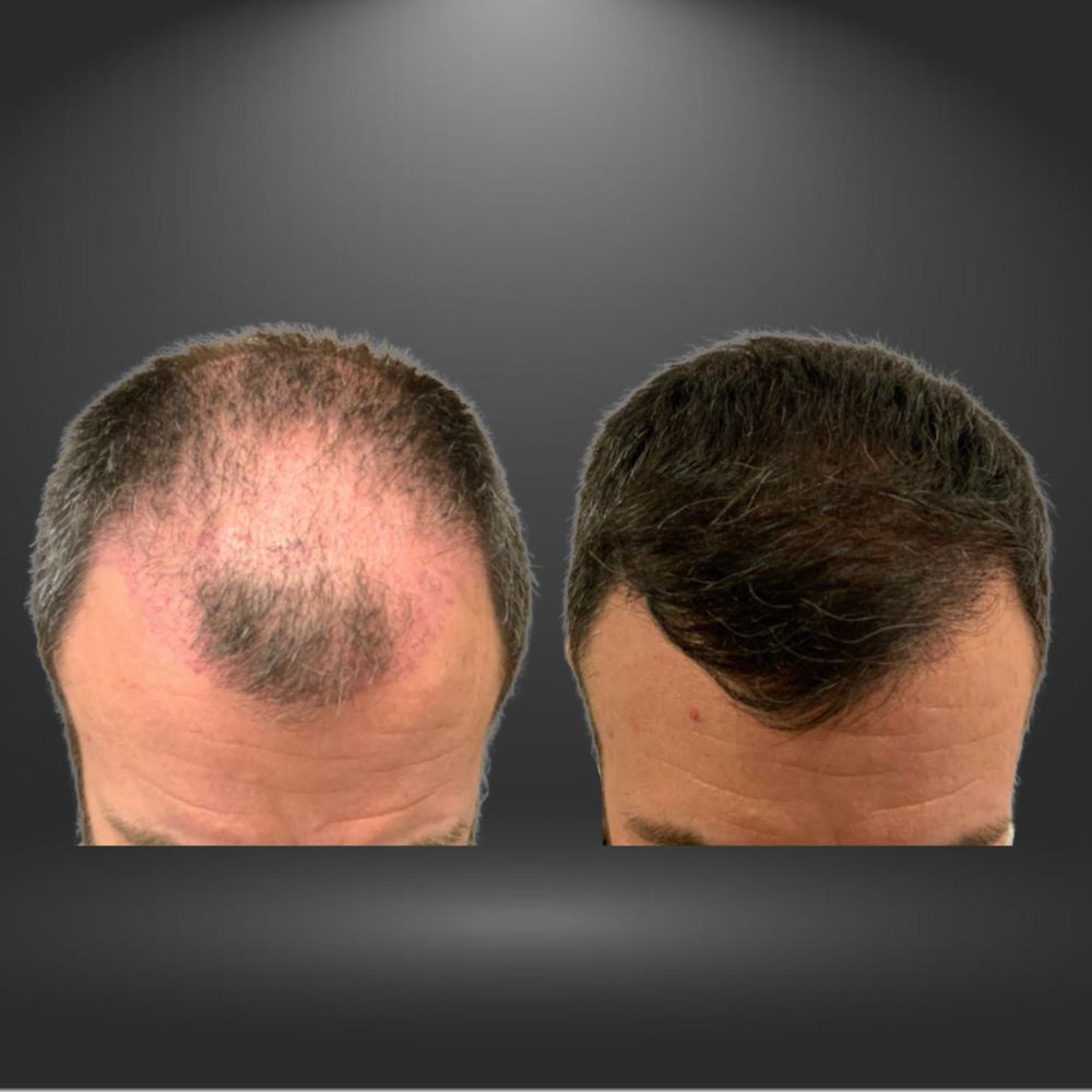 Hair restoration 2