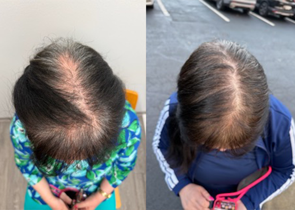 Hair restoration 3