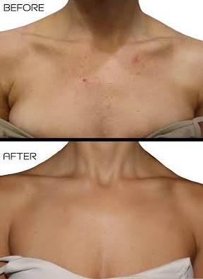 Microneedling for chest Before-After