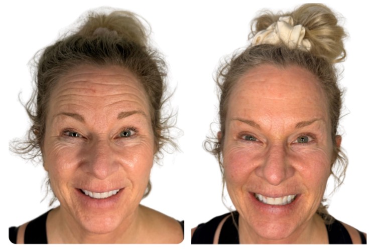 TOX Before-After 2